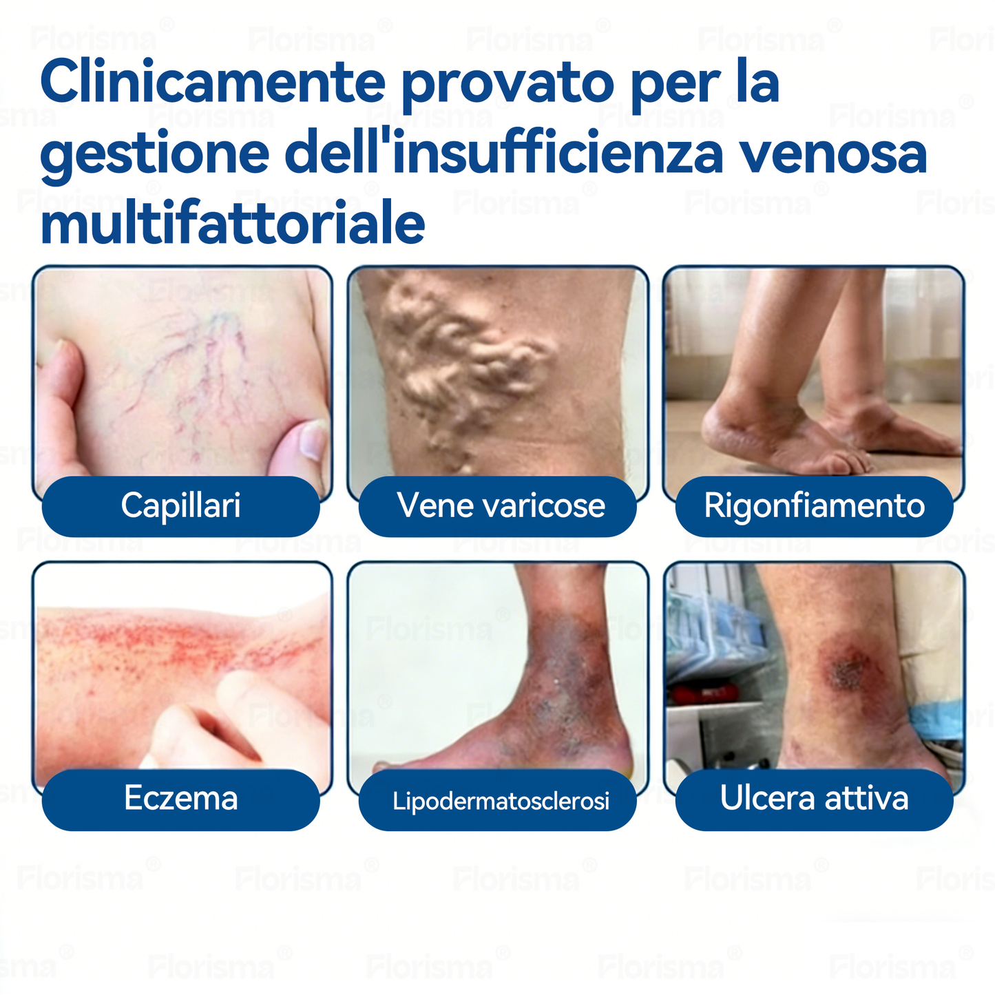 🛡️ 𝑭𝑳𝑶𝑹𝑰𝑺𝑴𝑨® 💕 Cerotto Microneedle di Grado Clinico (con Diosmina ed Esperidina) — Progettato specificamente per contrastare i capillari visibili e le vene varicose, aiutando al contempo ad alleviare la sensazione di gambe pesanti e affaticate. 👩‍⚕️