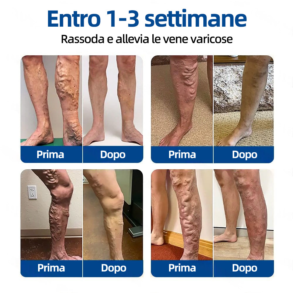 🛡️ 𝐅𝐥𝐨𝐫𝐢𝐬𝐦𝐚® 💕 Cerotto Microneedle di Grado Clinico (con Diosmina ed Esperidina) — Progettato specificamente per contrastare i capillari visibili e le vene varicose, aiutando al contempo ad alleviare la sensazione di gambe pesanti e affaticate. 👩‍⚕️
