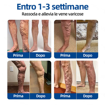 🛡️ 𝐅𝐥𝐨𝐫𝐢𝐬𝐦𝐚® 💕 Cerotto Microneedle di Grado Clinico (con Diosmina ed Esperidina) — Progettato specificamente per contrastare i capillari visibili e le vene varicose, aiutando al contempo ad alleviare la sensazione di gambe pesanti e affaticate. 👩‍⚕️